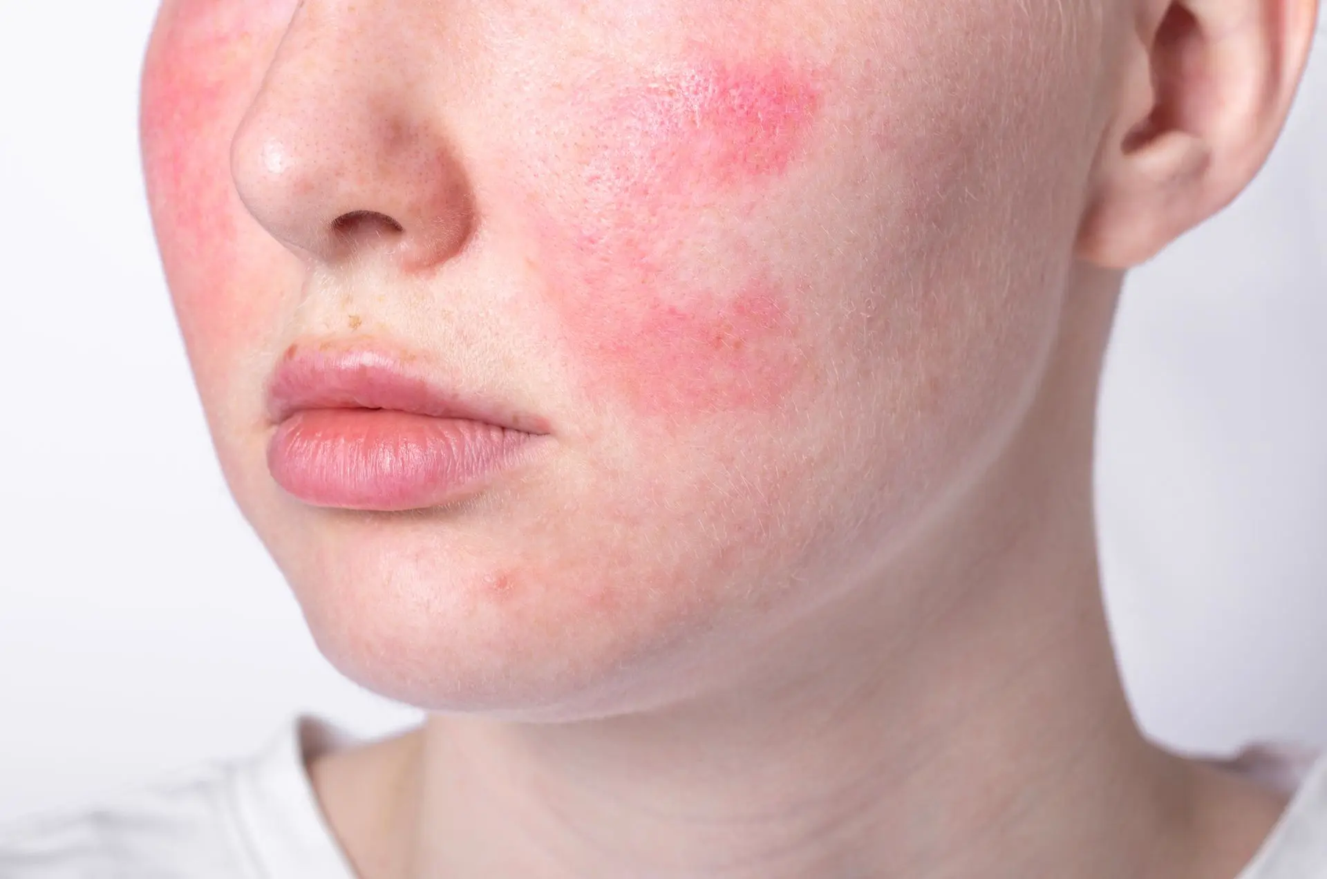Redness and skin texture treatment at Eclipse Spa